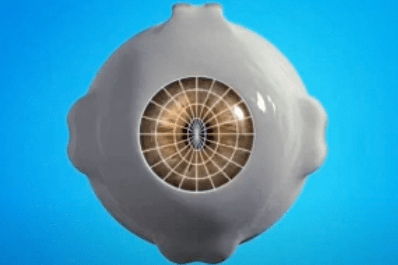L'astigmatime est une déformation ovoide de la cornée, entrainant des troubles de la focalisation lumineuse. Il se traite en lunettes, lentilles, ou par chirurgie réfractive