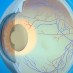 La cataracte désigne l'opacification du cristallin, la lentille naturelle de l'œil destinée à réaliser la mise au point. L'opacification gêne les entrées lumineuses dnas l'œil, causant une baisse de vision progressive.