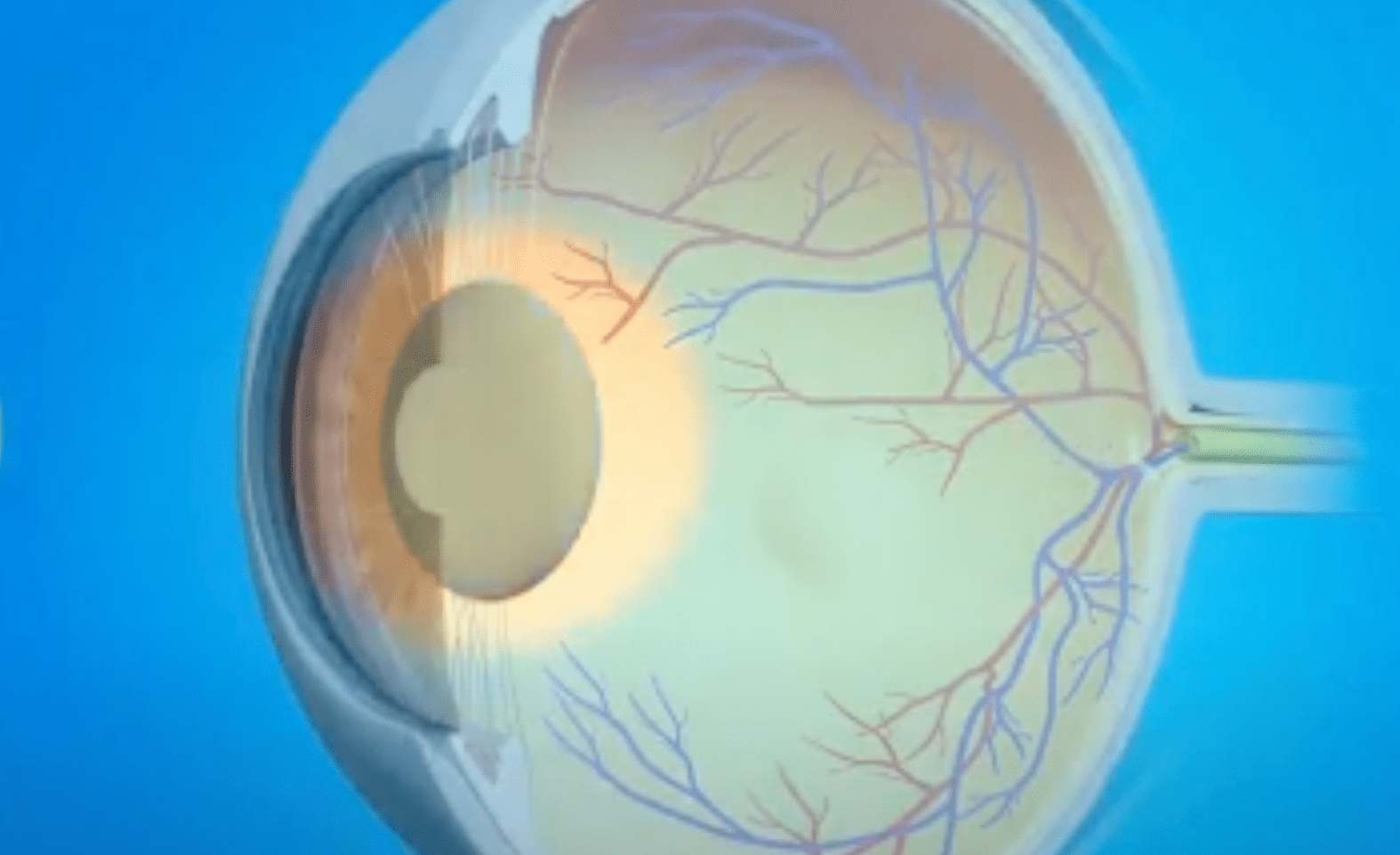 Chirurgie réfractive de la cataracte