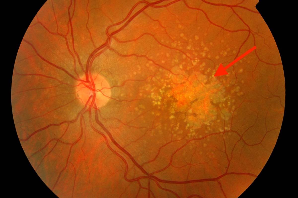 DMLA - Dégénérescence maculaire liée à l'âge. Perte de vision progressive (forme humide) ou brutale (forme sèche), liée à l'accumulation de drusen (débris de photorécepteurs) sous la rétine centrale (la macula)