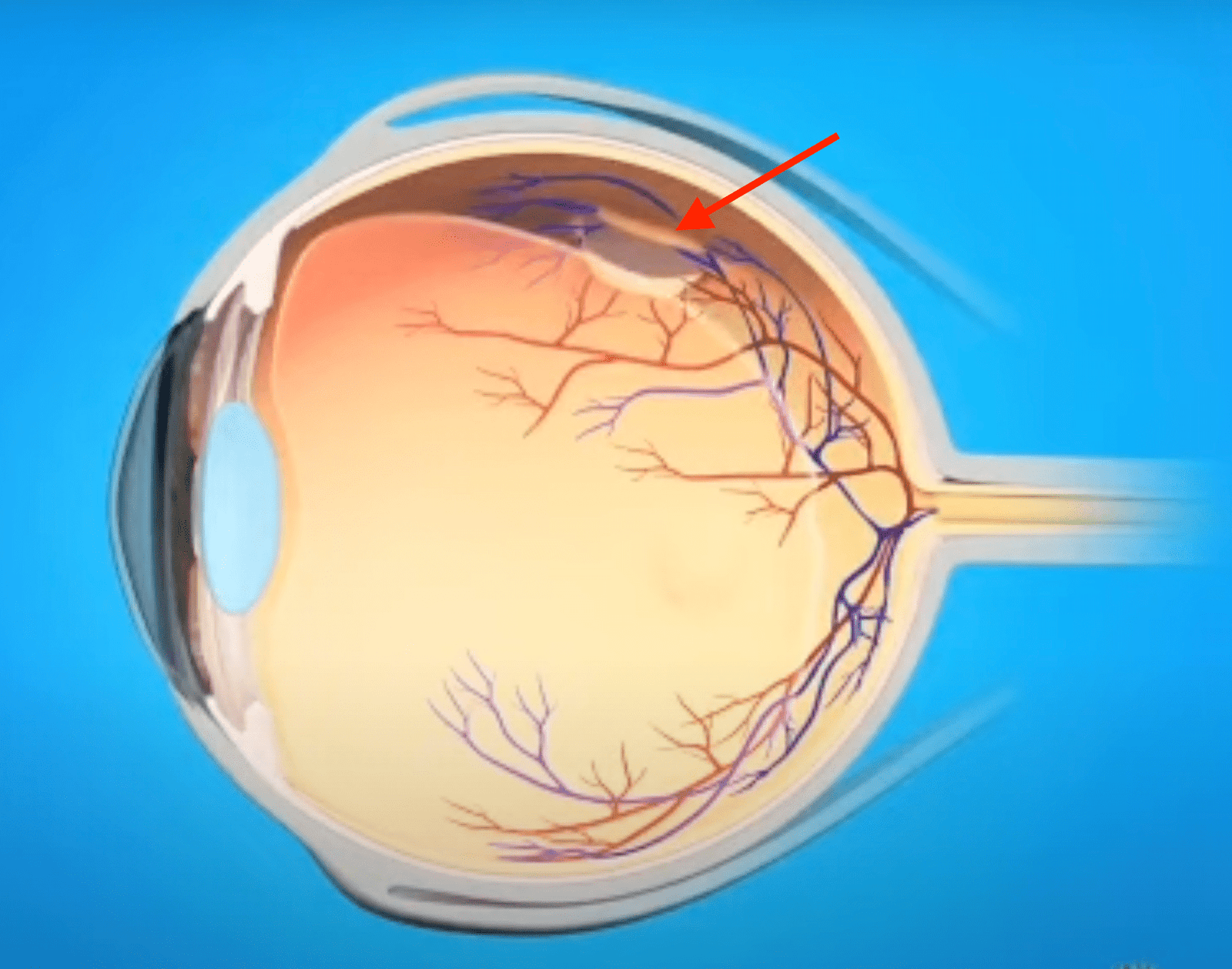 Déchirure de rétine - Présence d'une brèche dans la rétine à risque d'évoluer vers un décollement de rétine. La déchirure se traite par cautérisation au laser ou cryo-application (froid)