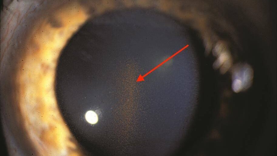 Dyspersion pigmentaire : présence de pigment irien en suspesion dans la chambre antérieure, responsable d'une obstruction du trabéculum et d'une augmentation de la tension oculaire pouvant évoluer vers le glaucome