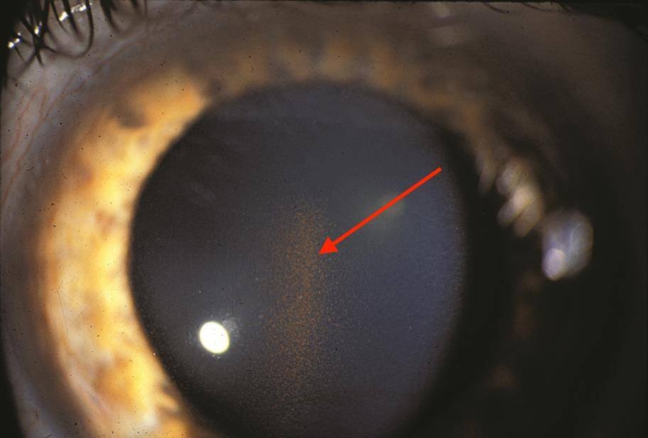 Dyspersion pigmentaire : présence de pigment irien en suspesion dans la chambre antérieure, responsable d'une obstruction du trabéculum et d'une augmentation de la tension oculaire pouvant évoluer vers le glaucome
