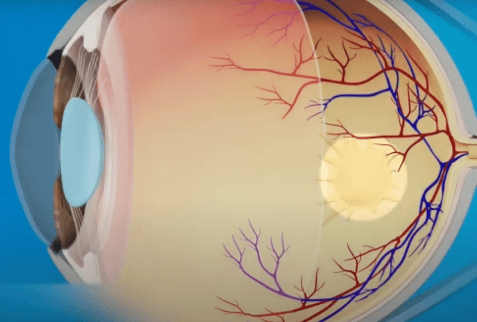 La membrane épirétinienne désigne la pousse d'une couche de cellules sur la macula, la froissant et déformant la vision