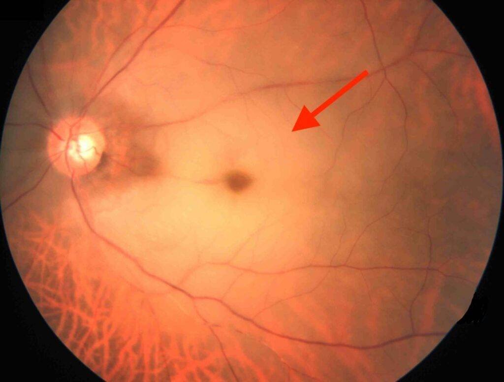 Occlusion de l'artère centrale de la rétine - AVC ischémique de l'œil responsable d'une perte de vision brutale et définitive.