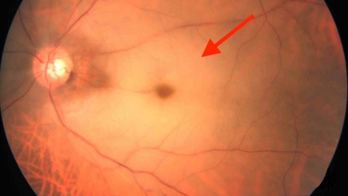 Occlusion de l'artère centrale de la rétine - AVC de l'œil