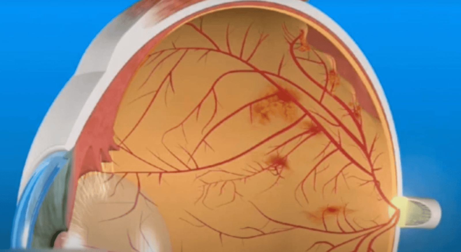Rétinopathie diabétque : complication oculaire d'un déséquilibre chronique du diabète entrainant la formation de néovaisseaux pouvant saigner ou décoller la rétine.