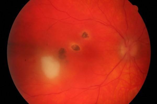 Toxoplasmose oculaire - Inflammation de la rétine et de la choroïde liée à un parasite : toxoplasma gondii