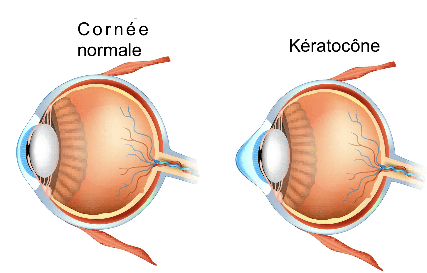 Kératocône - Astigmatisme irrégulier causé par les frottements oculaires