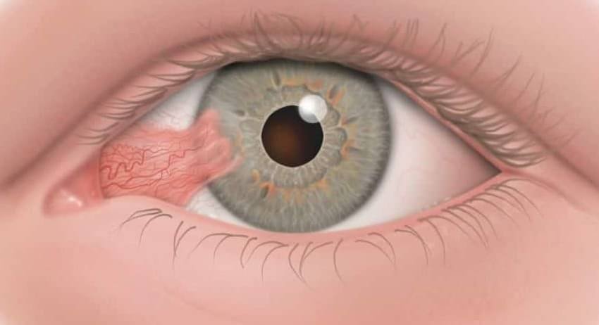 Ptérygion - Excroissance de peau sur la cornée en avant de la pupille
